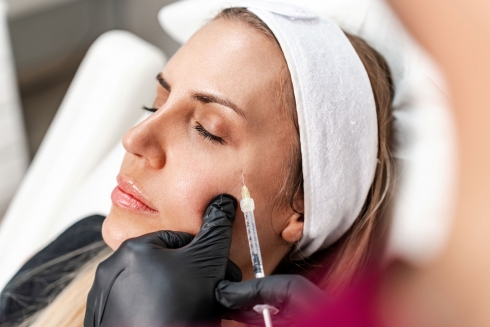 injection pommettes visage acide hyaluronique - Dr Ligeron - Montpellier