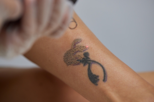 Le détatouage au laser d'un tatouage professionnel à montpellier