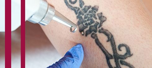 Détatouage au laser à Montpellier