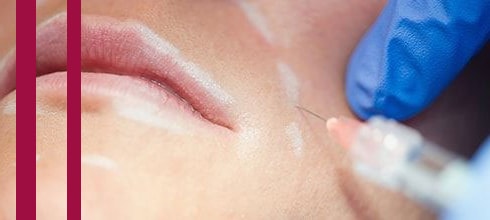 Injections d'acide hyaluronique et Botox à Montpellier